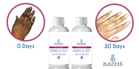 Solution For Elbow, Hands & Feet  Peel 16oz